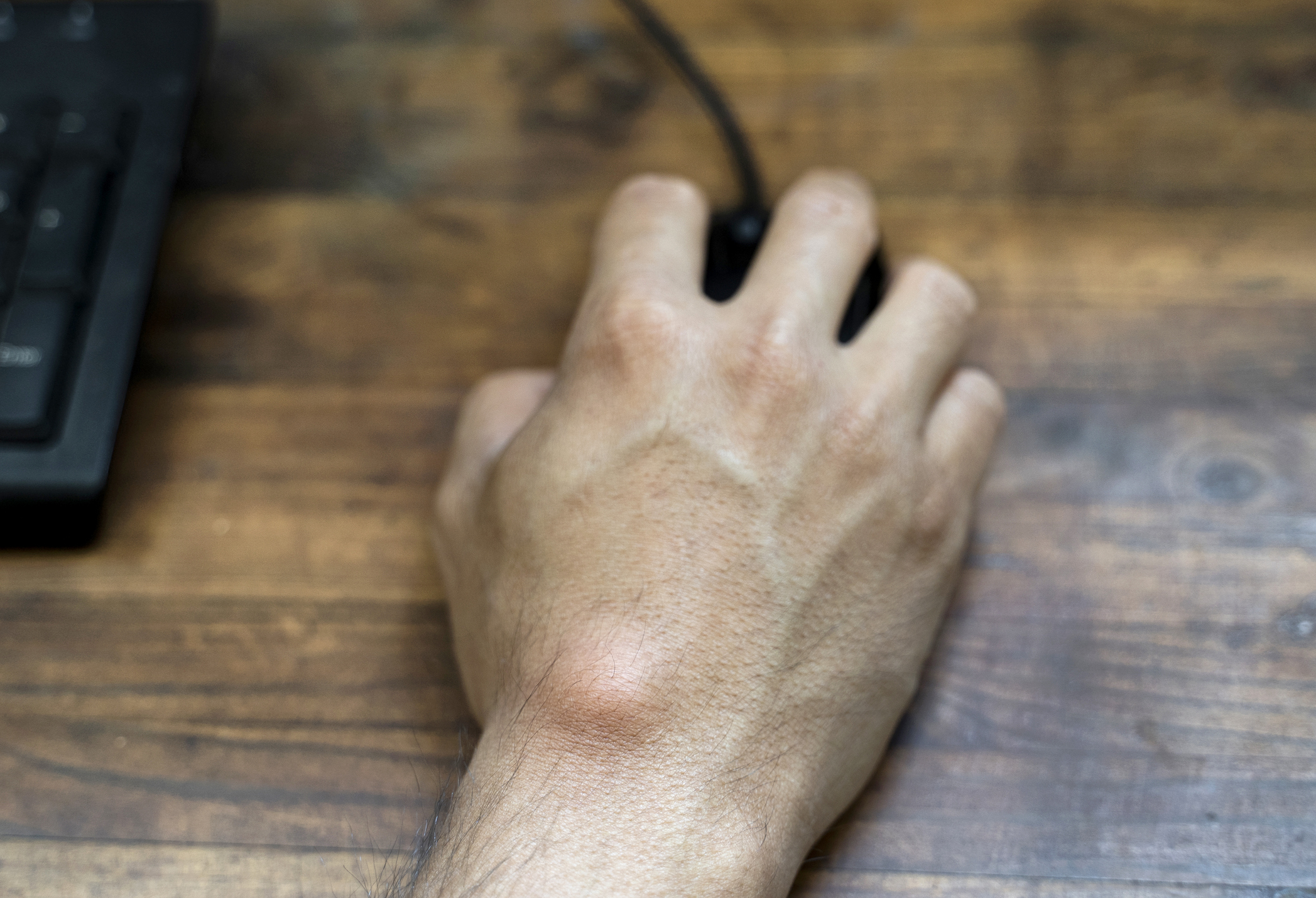 ganglion on hand