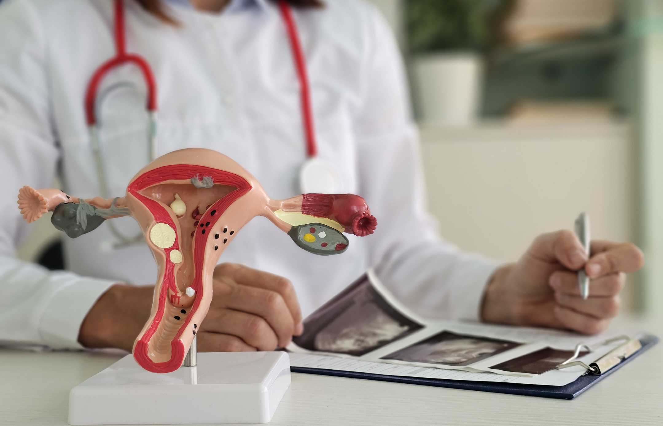 endometrial ablation graphic
