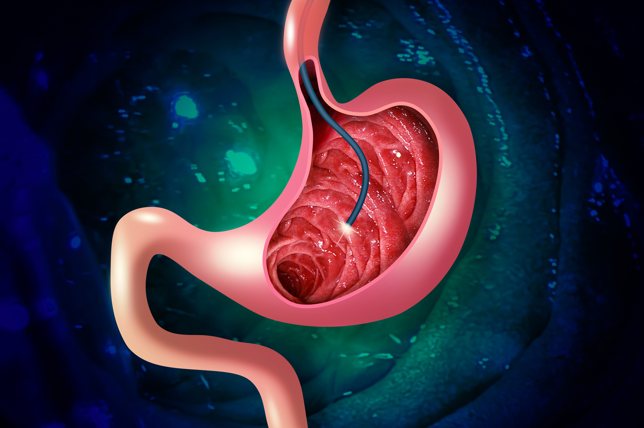 gastroscopy graphic