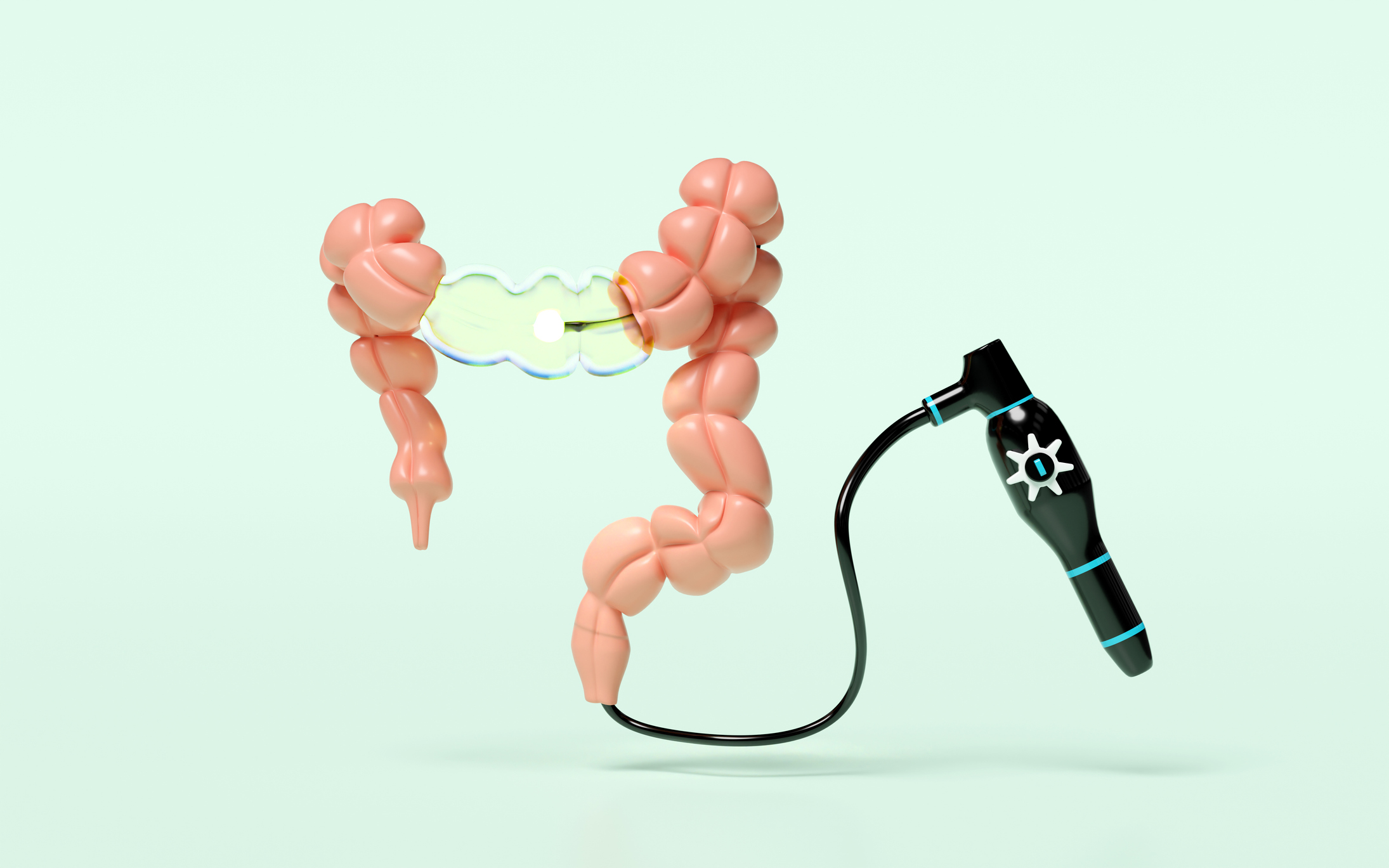 sigmoidoscopy graphic