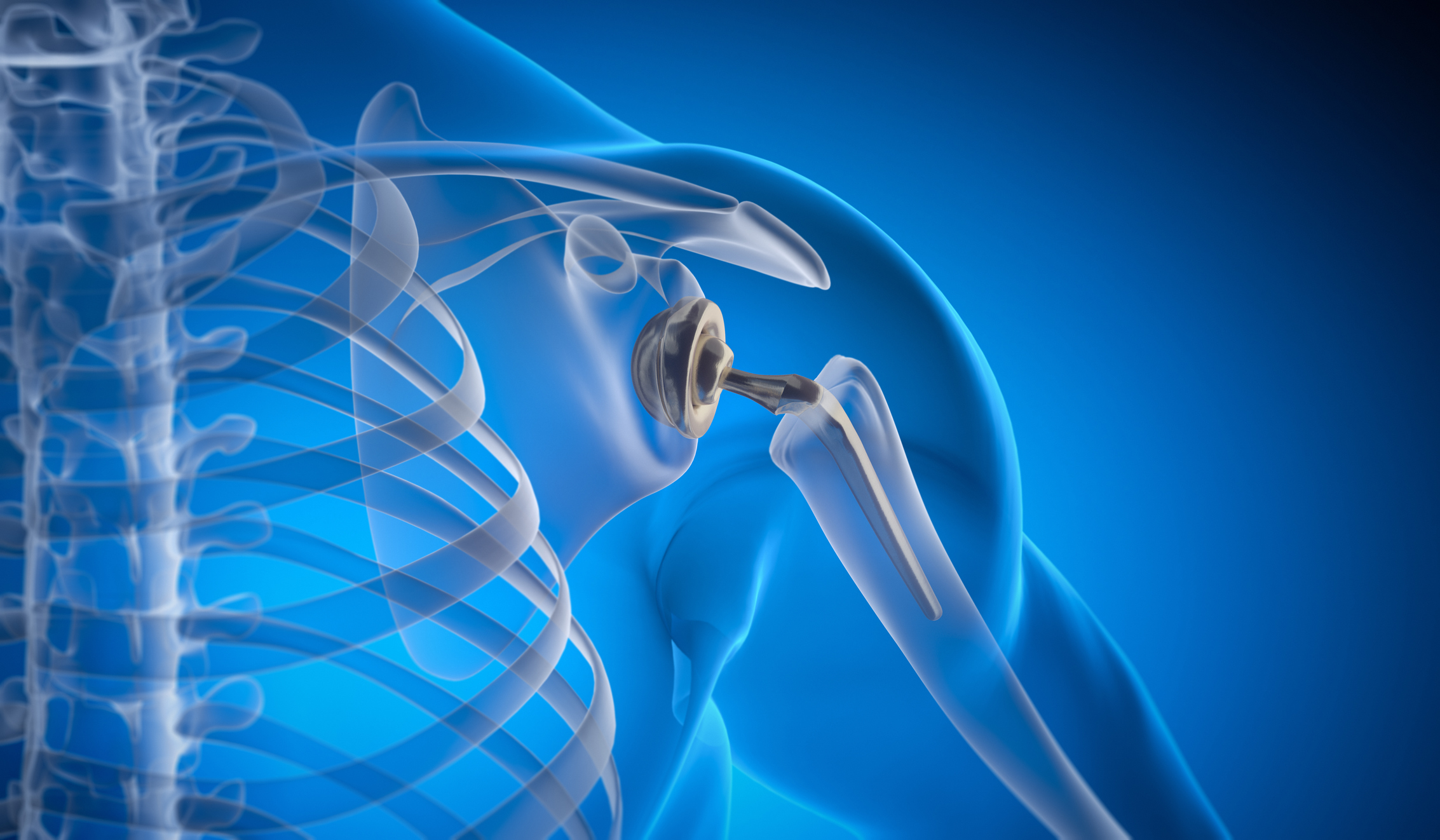 shoulder replacement graphic